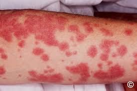steven johnson syndrome
