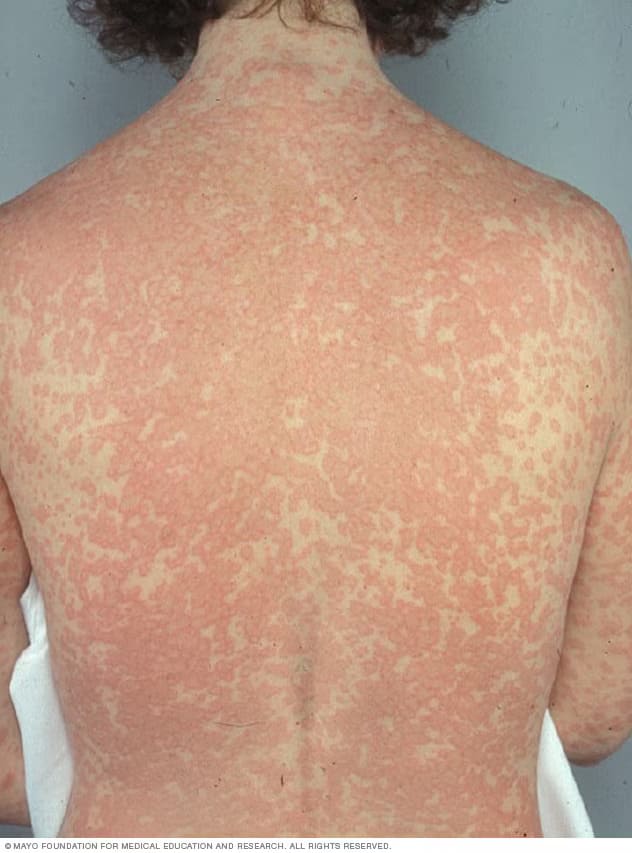 penicillin allergy rash urticaria vs sjs
