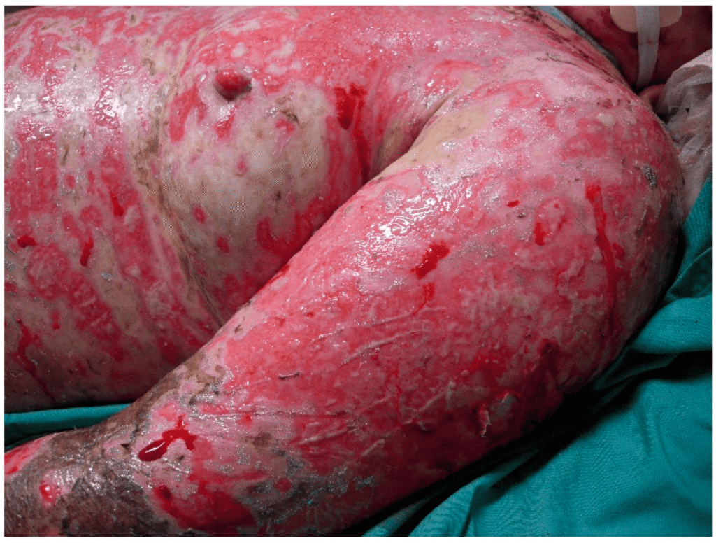 toxic epidermal necrolysis